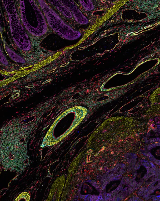 Colon adenocarcinoma and normal colon at the tumor margin