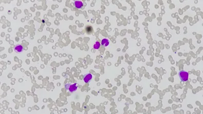 Acute myeloid leukemia (AML). Red blood cell. Blood smear microscopic 100x image.