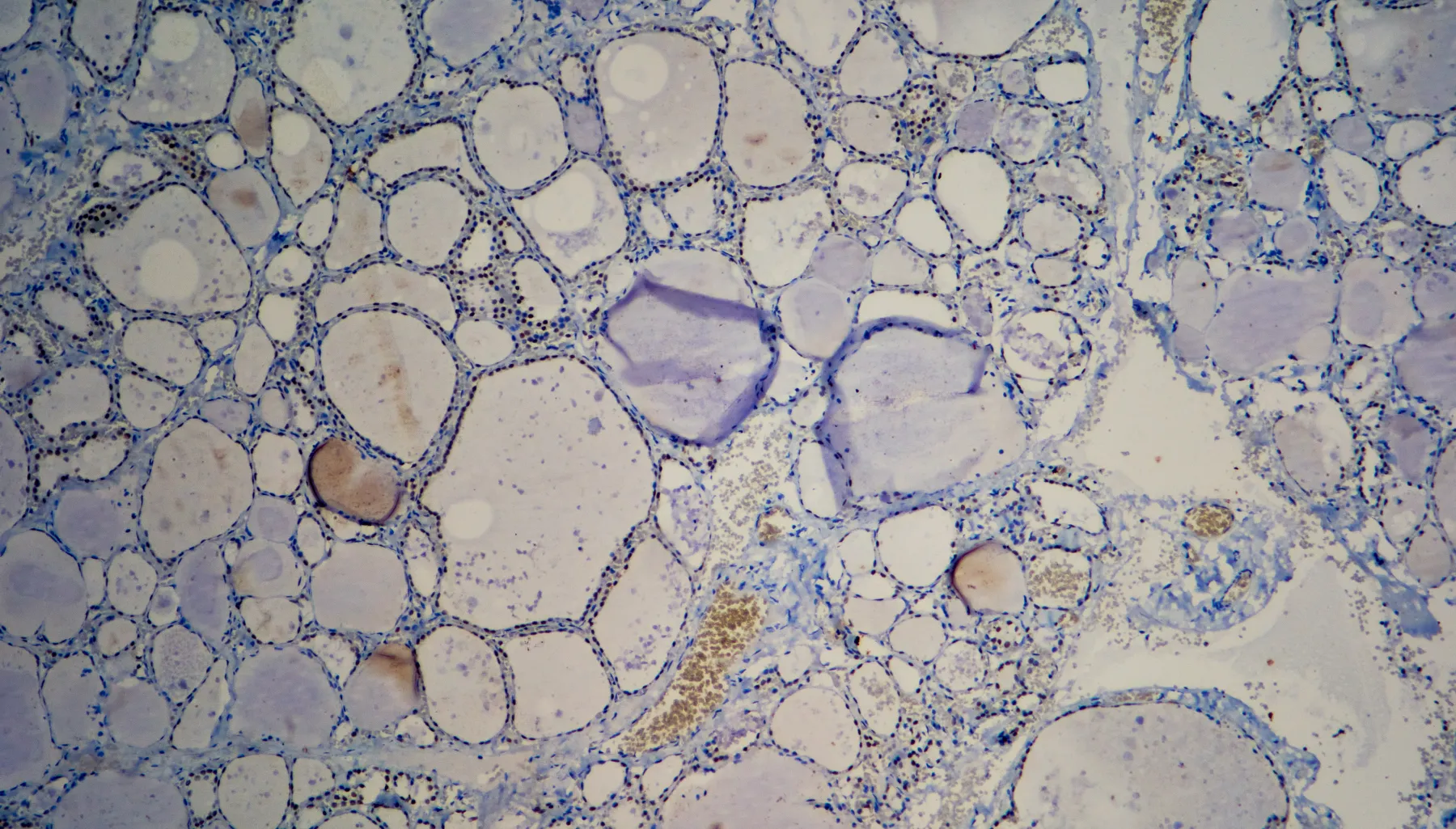 Immunohistochemistry TTF1 of the Thyroid
