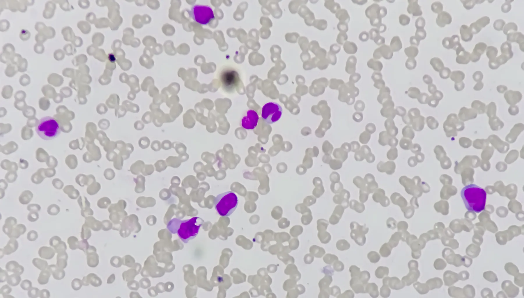 Acute myeloid leukemia (AML). Red blood cell. Blood smear microscopic 100x image.