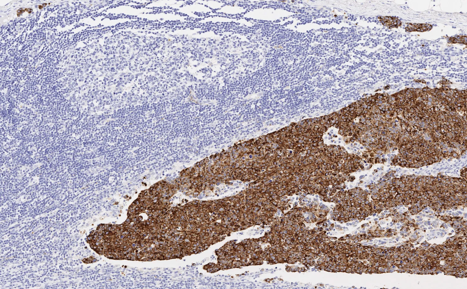 Metastatic breast cancer on a lymph node