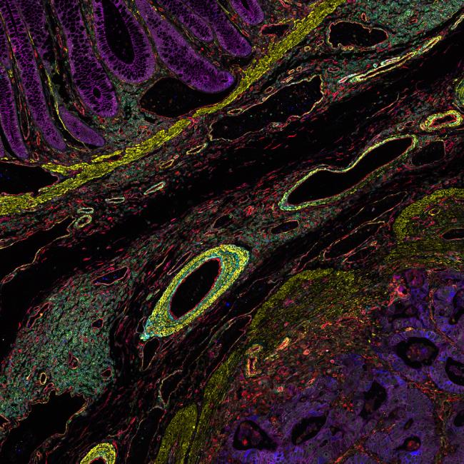 Colon adenocarcinoma and normal colon at the tumor margin
