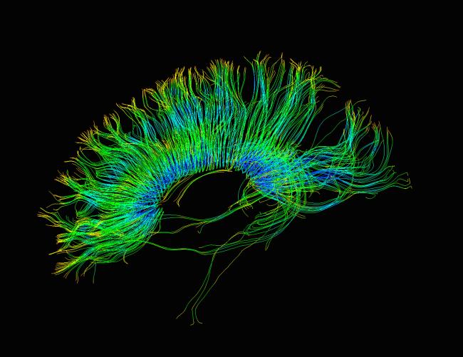 Diffusion MRI, also referred to as diffusion tensor imaging or DTI, of the human brain