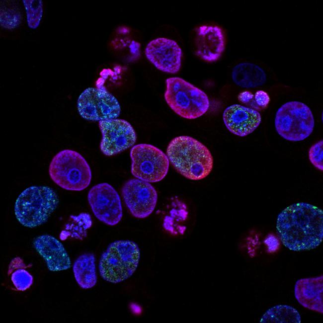 Human colorectal cancer cells treated with a topoisomerase inhibitor and an inhibitor of the protein kinase ATR (ataxia telangiectasia and Rad3 related), a drug combination under study as a cancer therapy. Cell nuclei are stained blue; the chromosomal protein histone gamma-H2AX marks DNA damage in red and foci of DNA replication in green. 